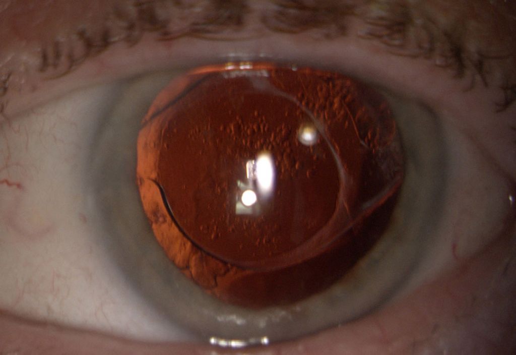 Yag Laser Capsulotomy Treatment Birmingham Mr Amit Patel