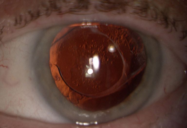 Yag Laser Capsulotomy Treatment Birmingham Mr Amit Patel